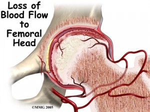 child_hip_transient_synovitis_causes01